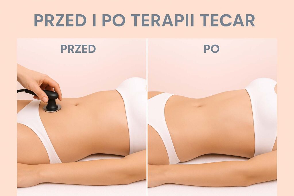 tecar na brzuch efekty